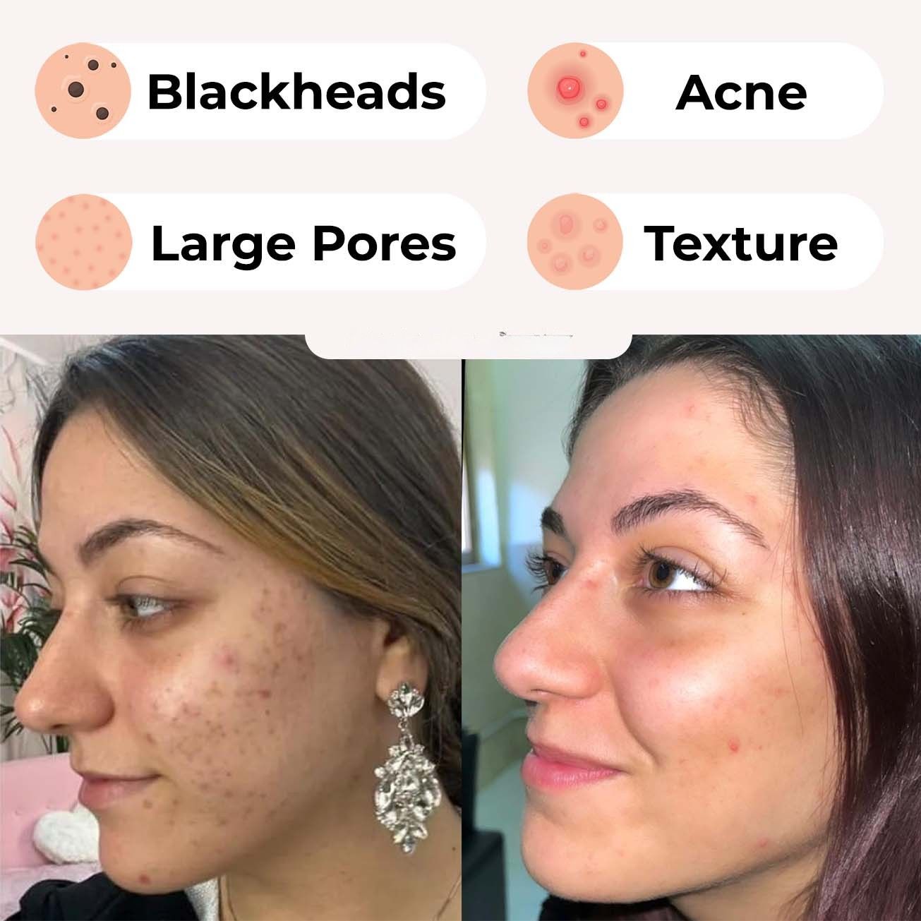 Blackhead Remover - Luluat